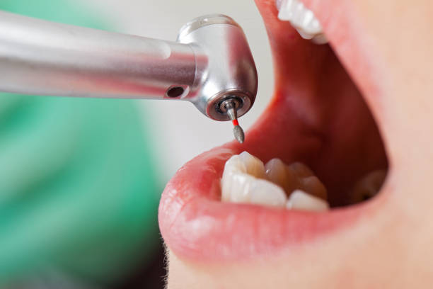 Best Emergency Wisdom Teeth Removal in Loveland, OH